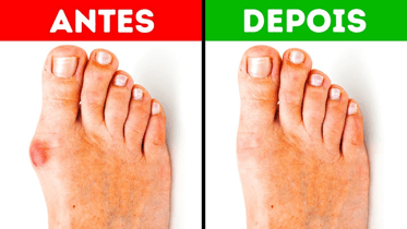 corretor de joanete