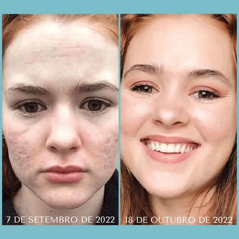 Micro agulhamento com acido hialuronico da bela vital resultados
