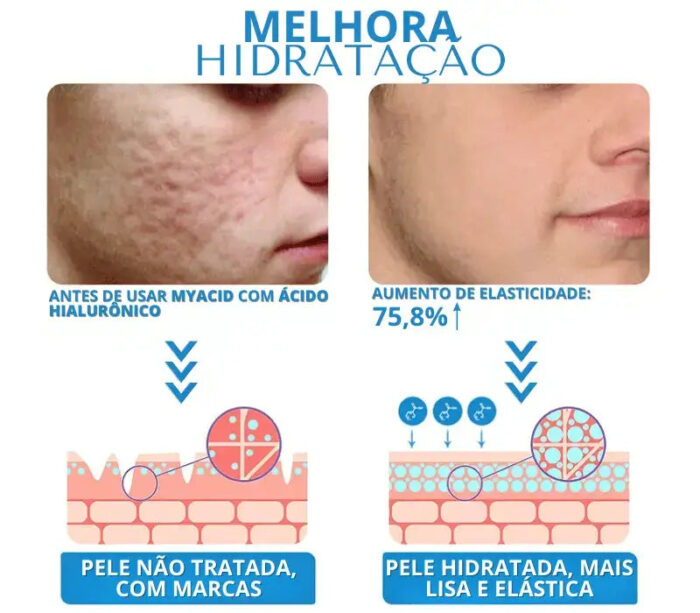 Microagulhamento com Serum Rejuvenescedor de Ácido Hialurônico - vipzio