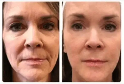 Cassia após a ação botox do veneno de cobra na pele da Bela Vital