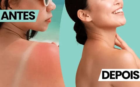 O Gel de Babosa Pode ser Utilizado na Remoção da Inflamação, além de ser um importante aliado para Queimaduras