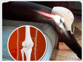 Kneecap Treasure e ArtiCure 2.0 - Terapia Ortopédica para Joelho 4 em 1 vipzio