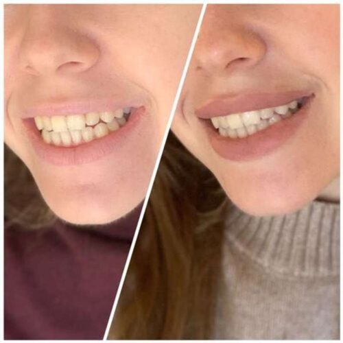 Clareador Dental Viya White photo review