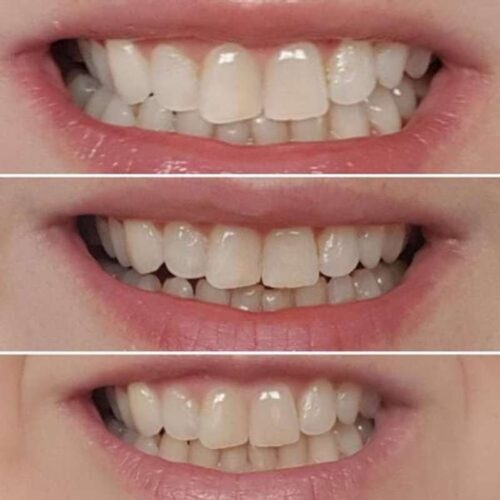 Clareador Dental Viya White photo review