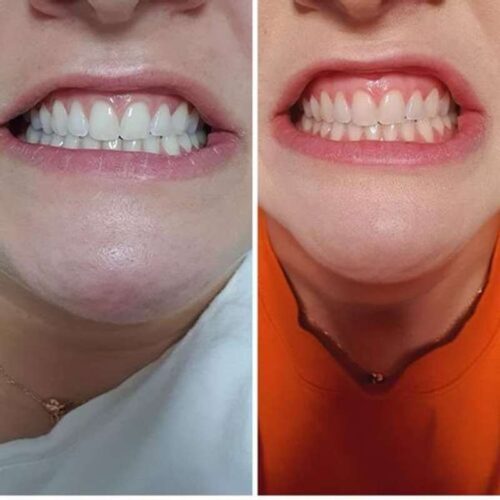 Clareador Dental Viya White photo review